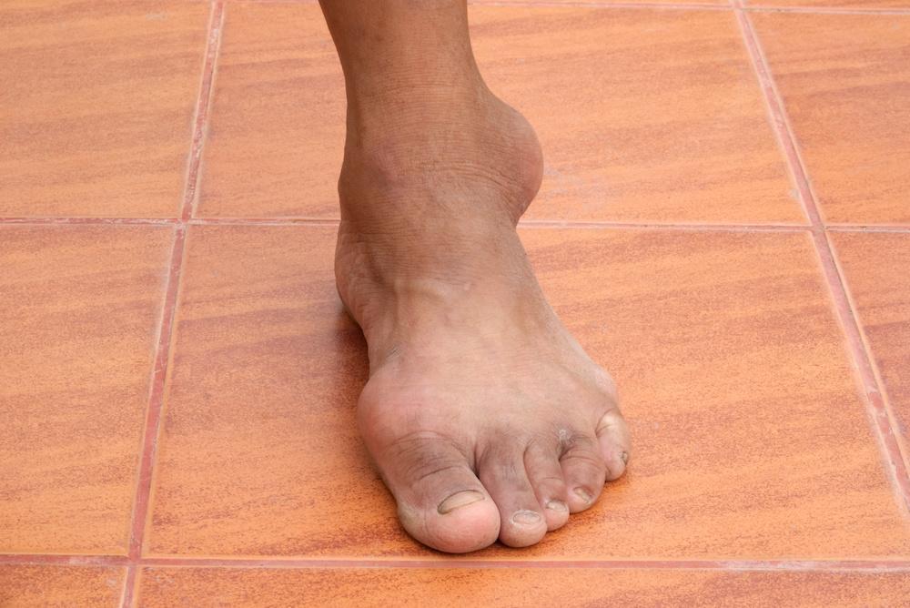 What is gout about?